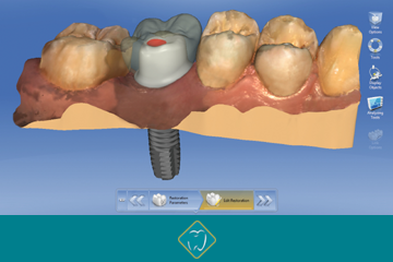 Implant dentar digital