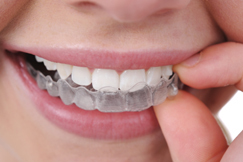 INVISALIGN: TRATAMENTO ORTODÔNTICO REVOLUCIONÁRIO - Barini Odontologia