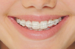 sapphire dental braces
